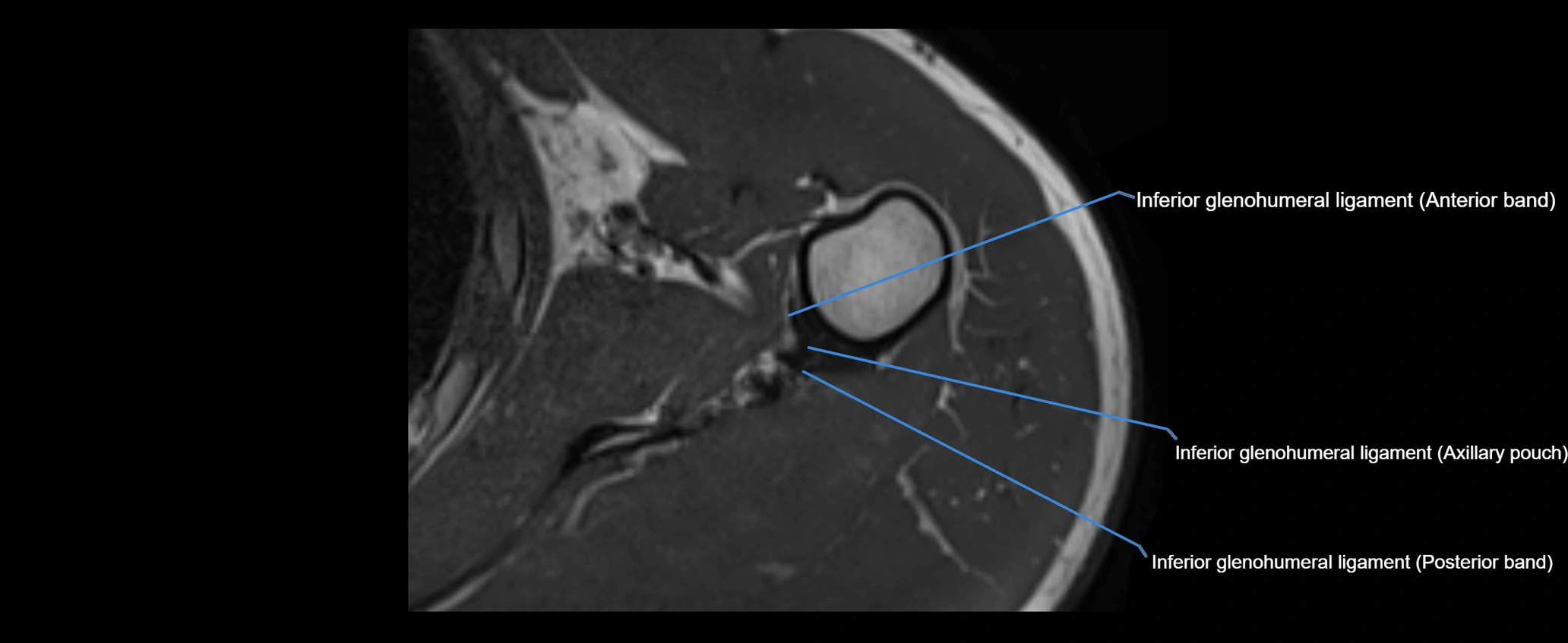 shoulder ligaments axial 3d 3t mri image-img-00005-00091.webp
